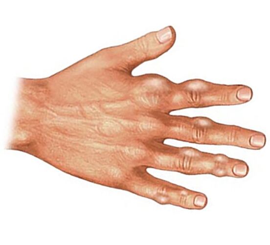 Deposición de cristais de ácido úrico nos tecidos brandos dos dedos con artrite gotosa