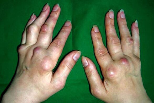 Mans afectadas pola poliosteoartrite deformante