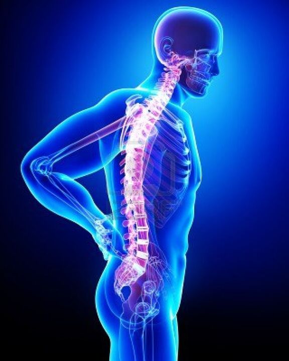 Columna vertebral humana afectada por osteocondrose