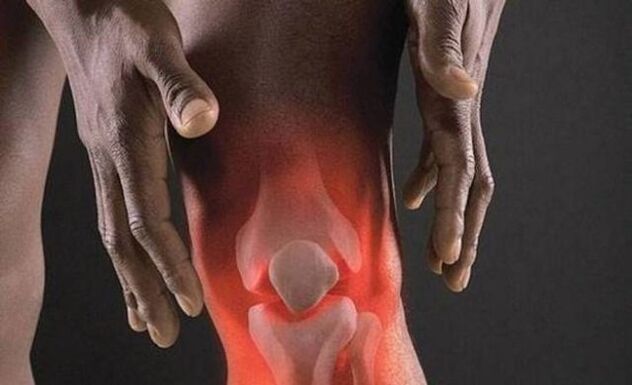 A artrose vai acompañada dun proceso inflamatorio na articulación do xeonllo