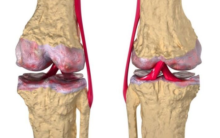 Artrose da articulación do xeonllo